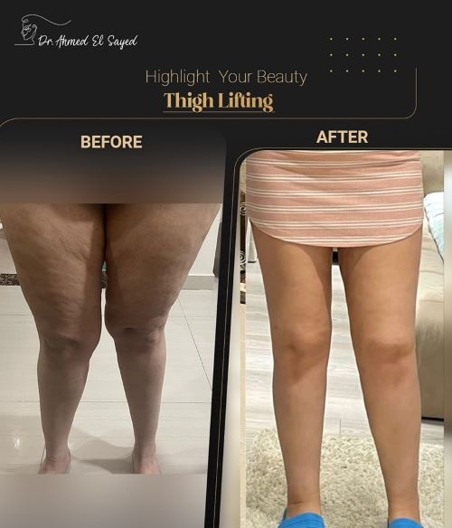 تجربتي مع شفط دهون الفخذين