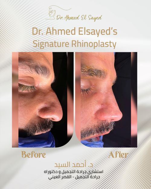 تجميل الأنف مع الدكتور أحمد السيد