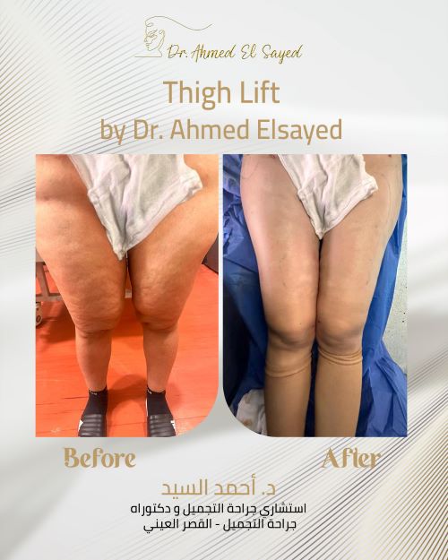 شد الأفخاذ مع الدكتور أحمد السيد