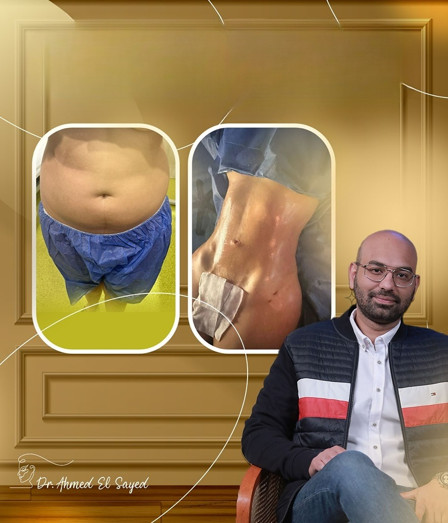 Liposuction-with-Other-Body-Contouring-Treatments