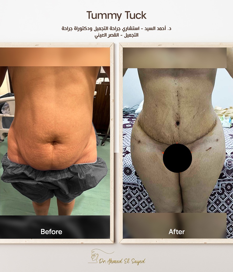 عملية-tummy-tuck
